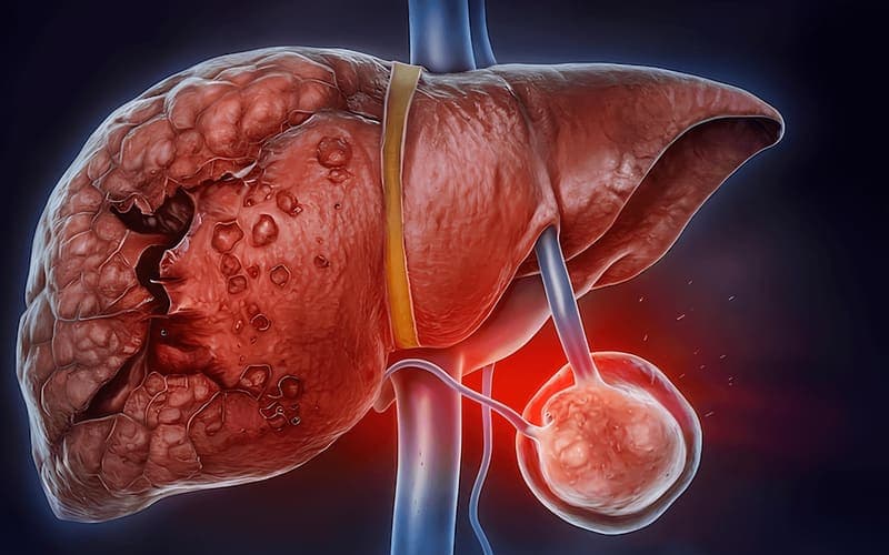 Gündeme Bakış: Uzmanından sevindiren 'Karaciğer Metastazı' açıklaması... Çaresiz değil!