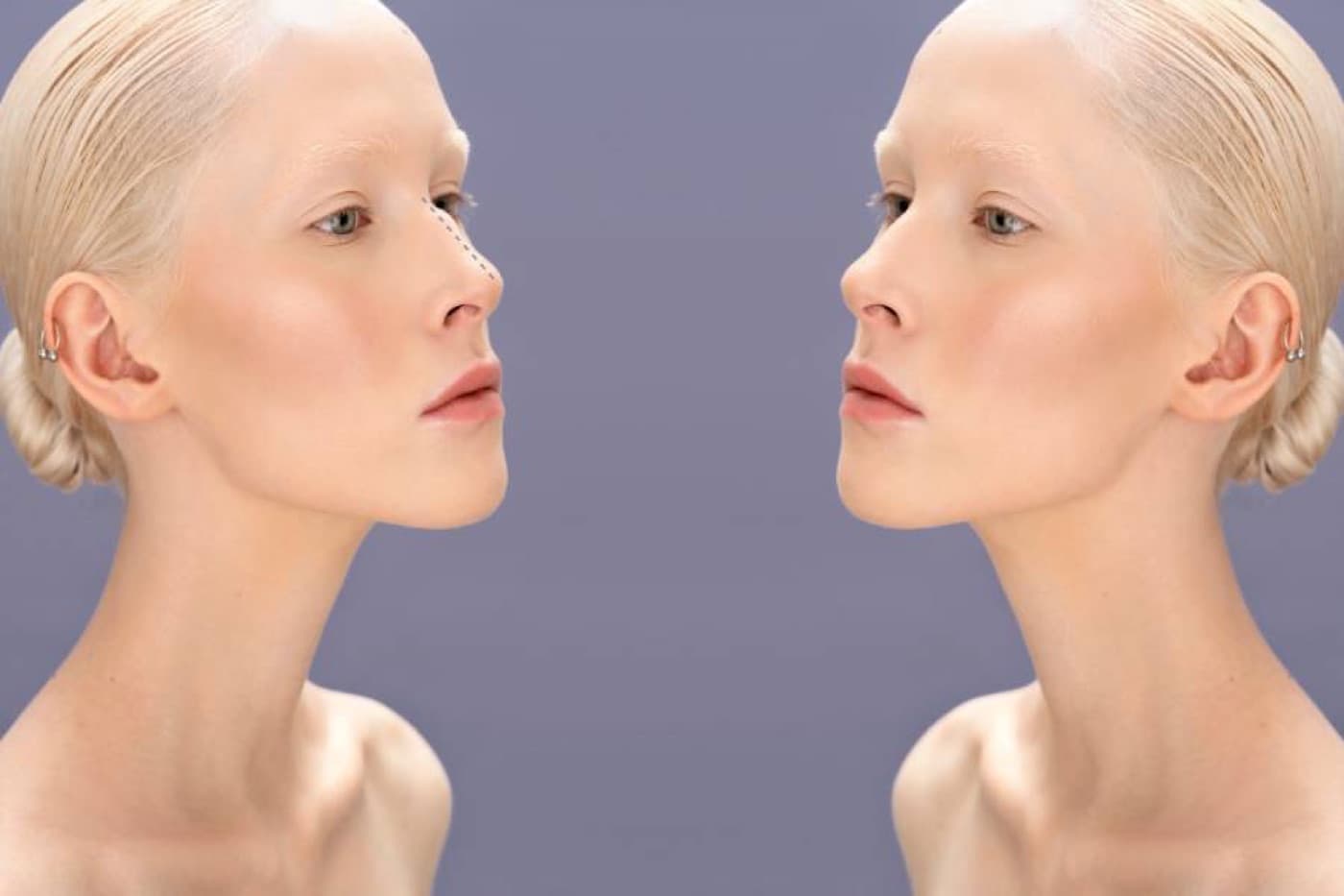 Septoplasti: Septum Deviasyonu nasıl düzeltir?