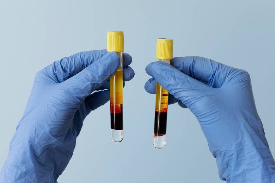 PRP Tedavisi nedir?
