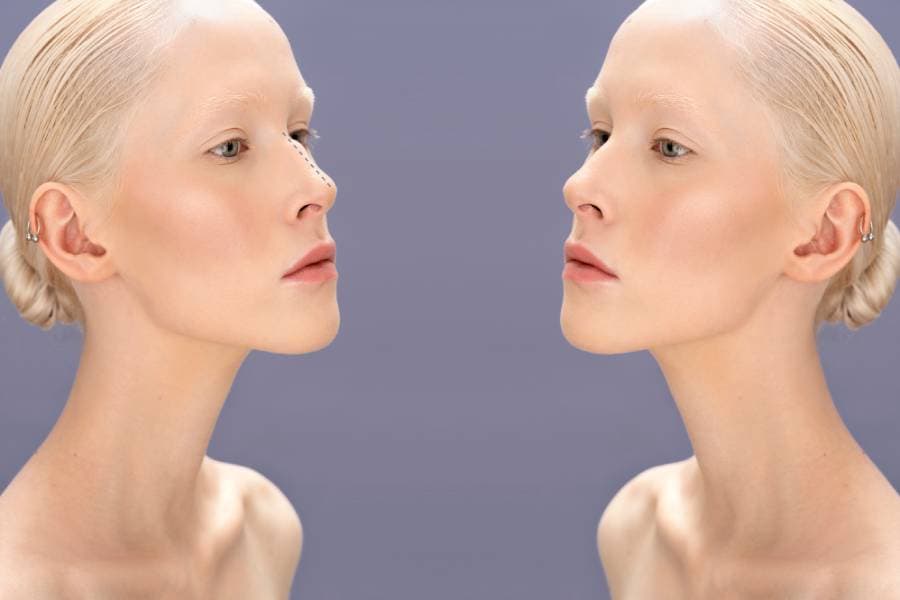 Septoplasti: Septum Deviasyonu nasıl düzeltir?