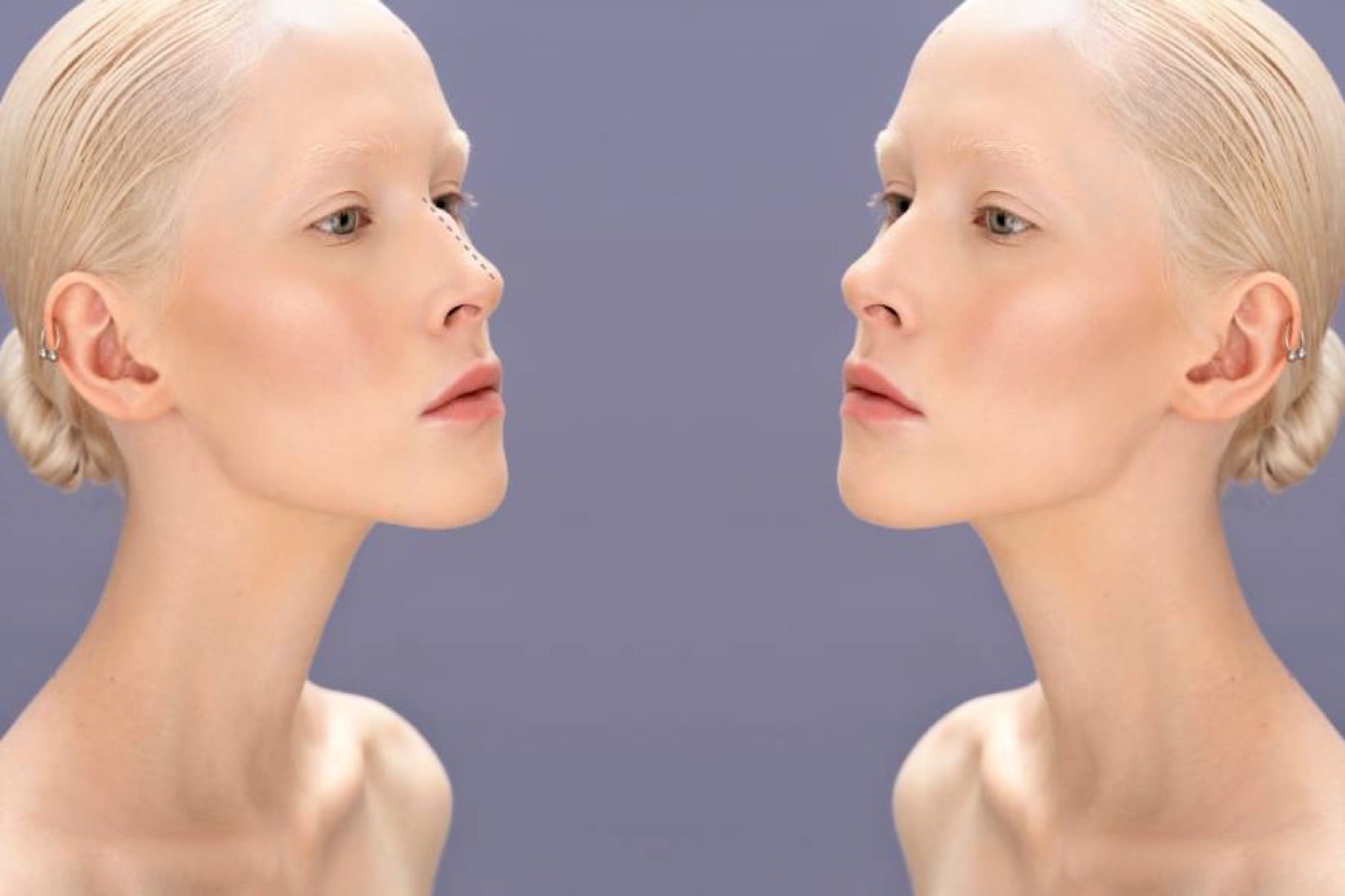Septoplasti: Septum Deviasyonu nasıl düzeltir?